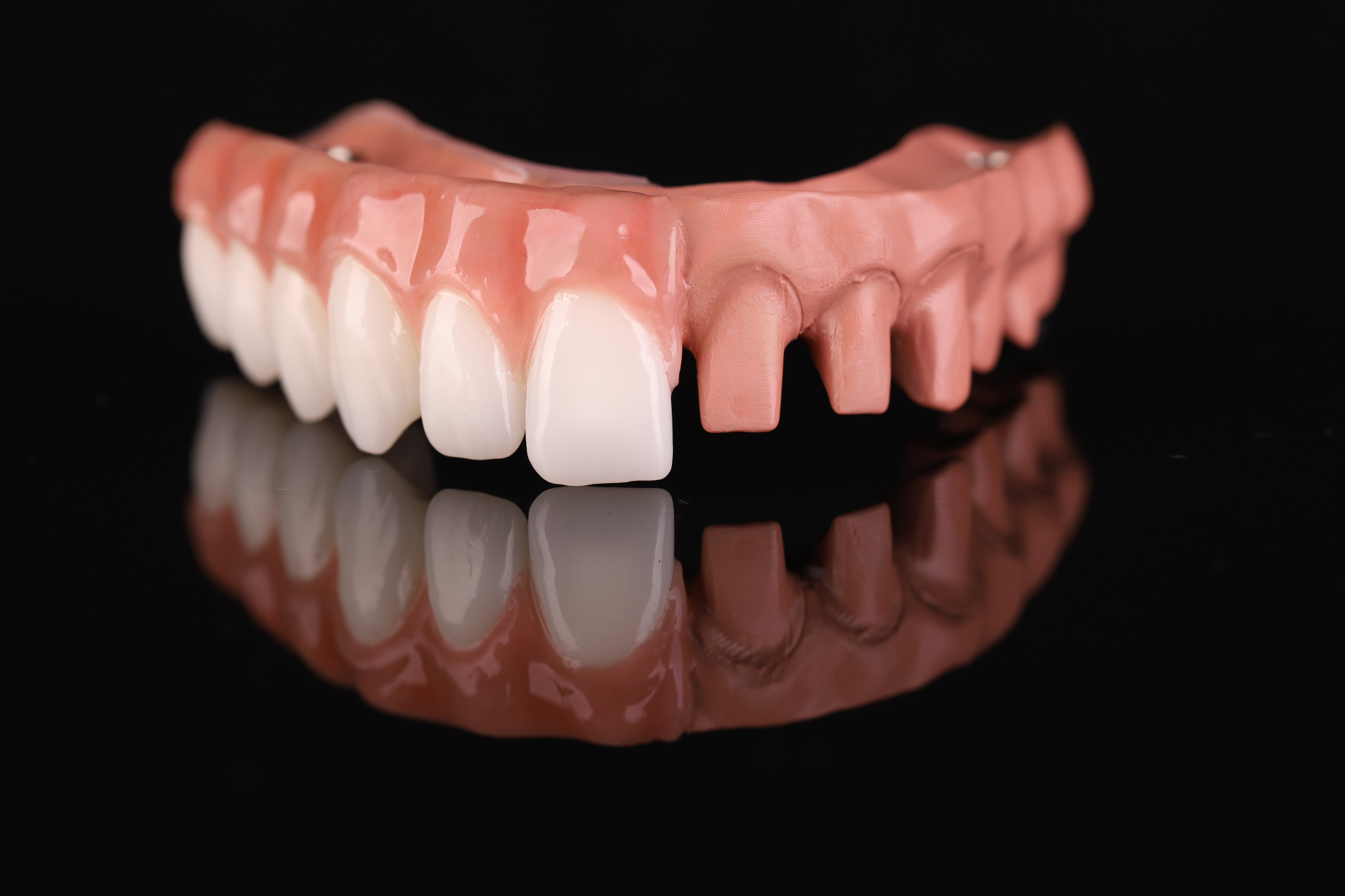 Two-part hybrid — TECNO MED MINERAL and zirconia crowns